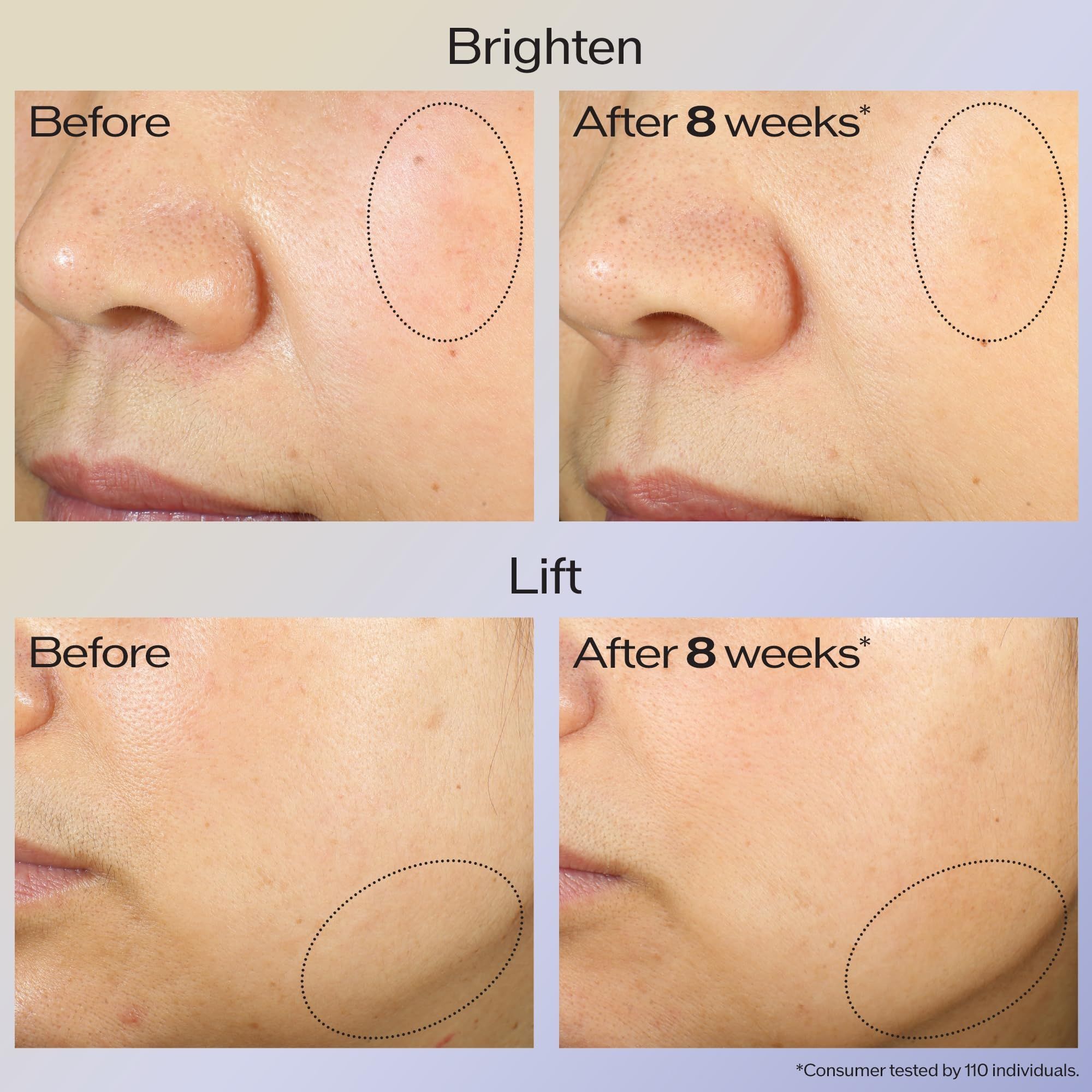Confronto prima-dopo di aree della pelle. Aree cerchiate. Testo: Brighten, Lift. Dopo 8 settimane.