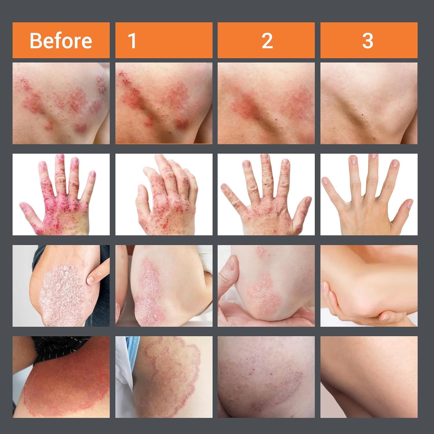 Immagini del prima e del dopo delle condizioni della pelle. Mostra eruzioni cutanee, eczema, psoriasi e prurito. 3 fasi di miglioramento.