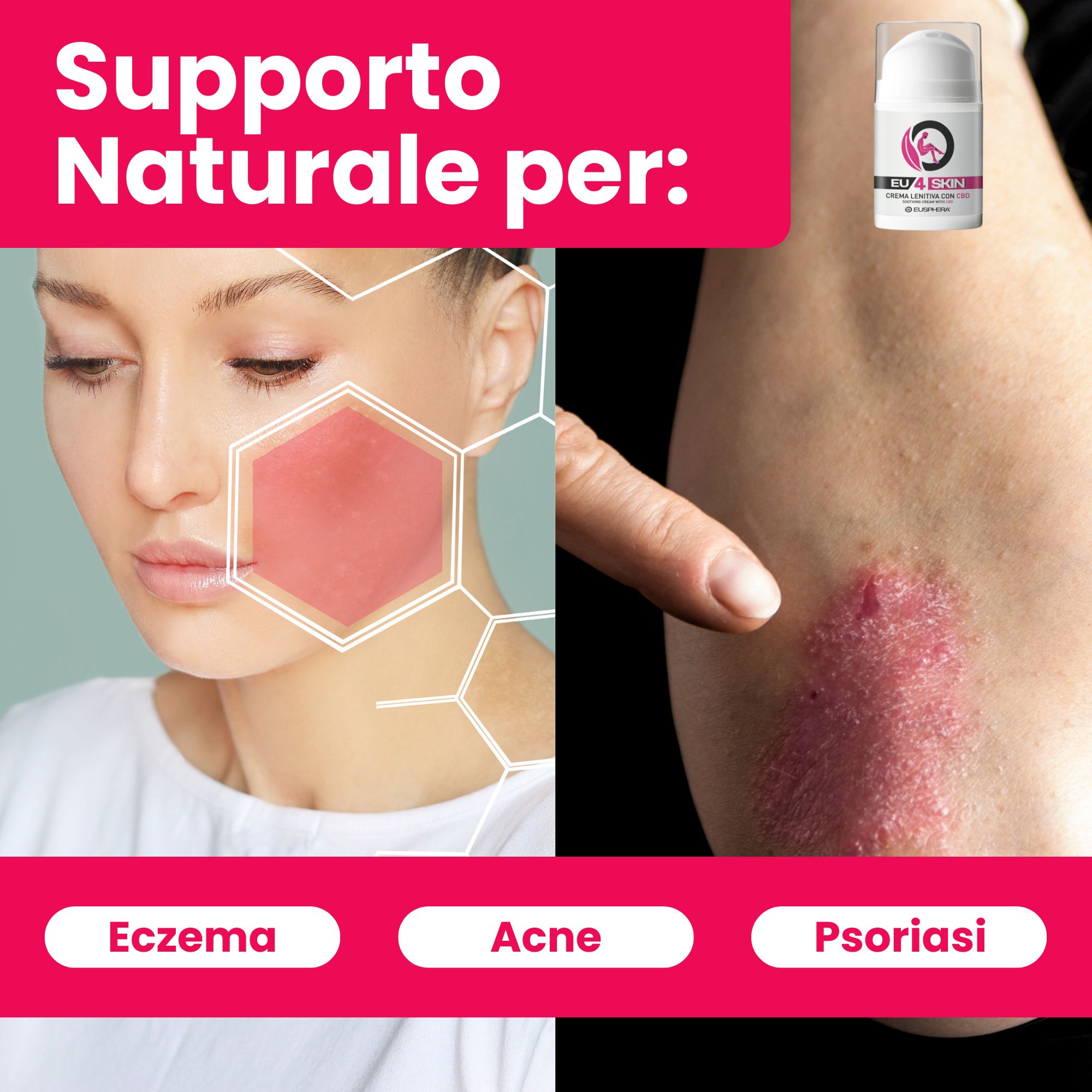 Crema pelle lenitiva al CBD per acne, eczema e psoriasi - Eusphera EU4SKIN