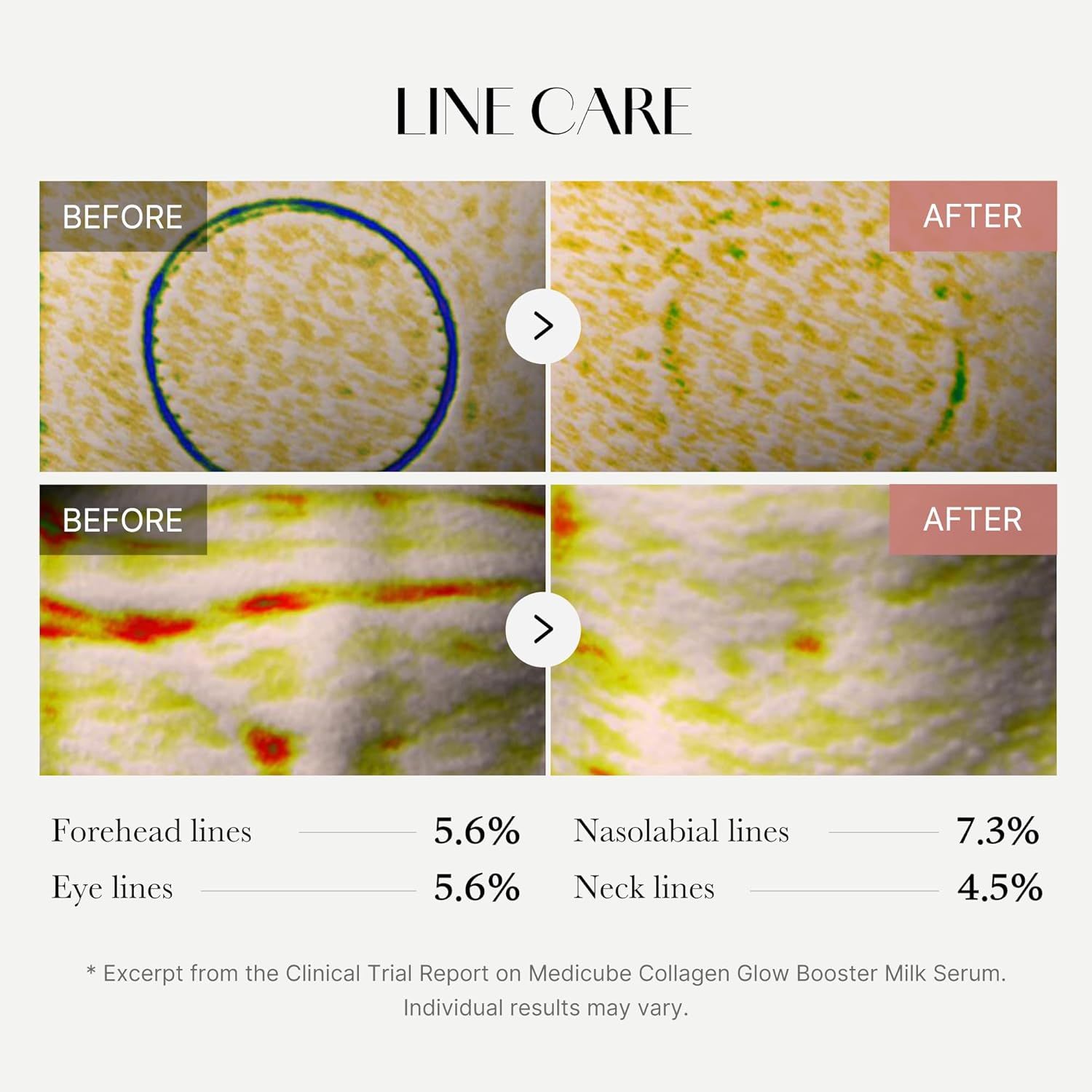 Confronto prima-dopo di immagini della pelle. Testo: Forehead lines 5.6%, Nasolabial lines 7.3%, Eye lines 5.6%, Neck lines 4.5%.