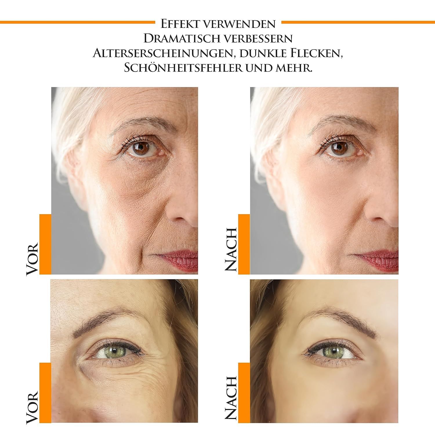 Confronto prima-dopo. Immagini delle zone degli occhi. Sinistra: prima. Destra: dopo. Riduzione di rughe e macchie.