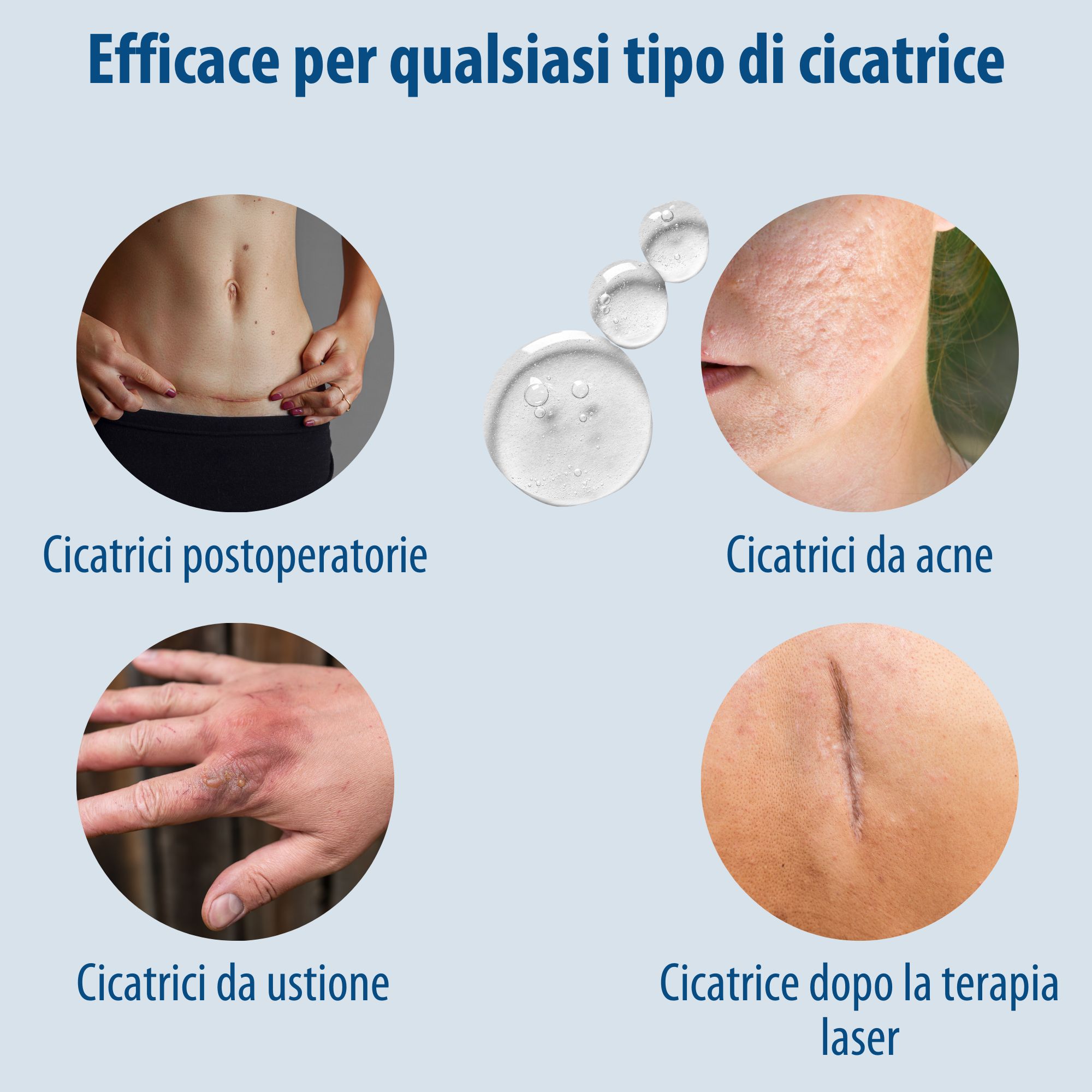 Evolsin Narbengel. Efficace su tutti i tipi di cicatrici: chirurgia, acne, ustioni, laser. Illustrazioni.