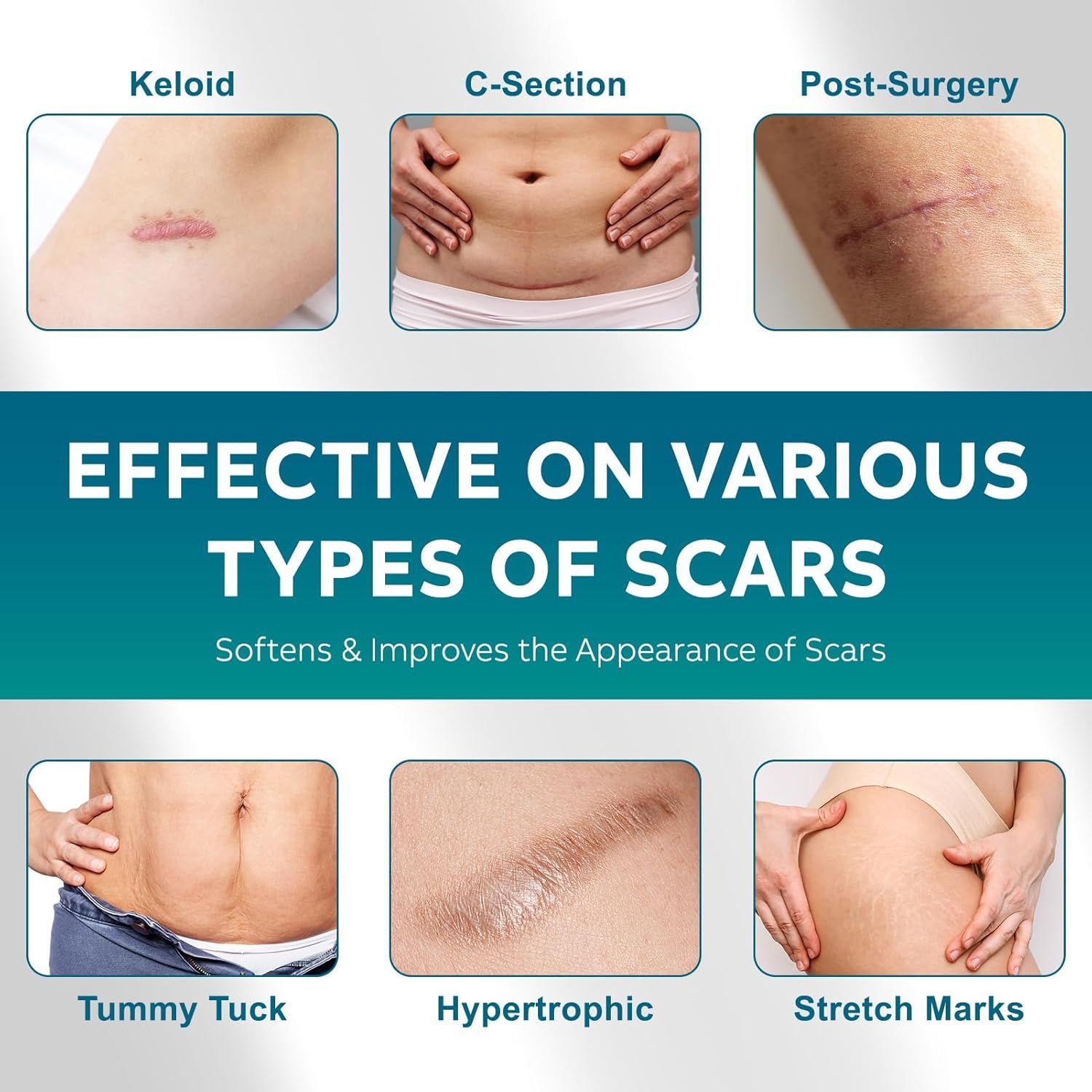 Tipi di cicatrici: cheloidi, cesarei, post-operatori, addominoplastica, ipertrofiche, smagliature. Testo: Efficace su vari tipi di cicatrici.