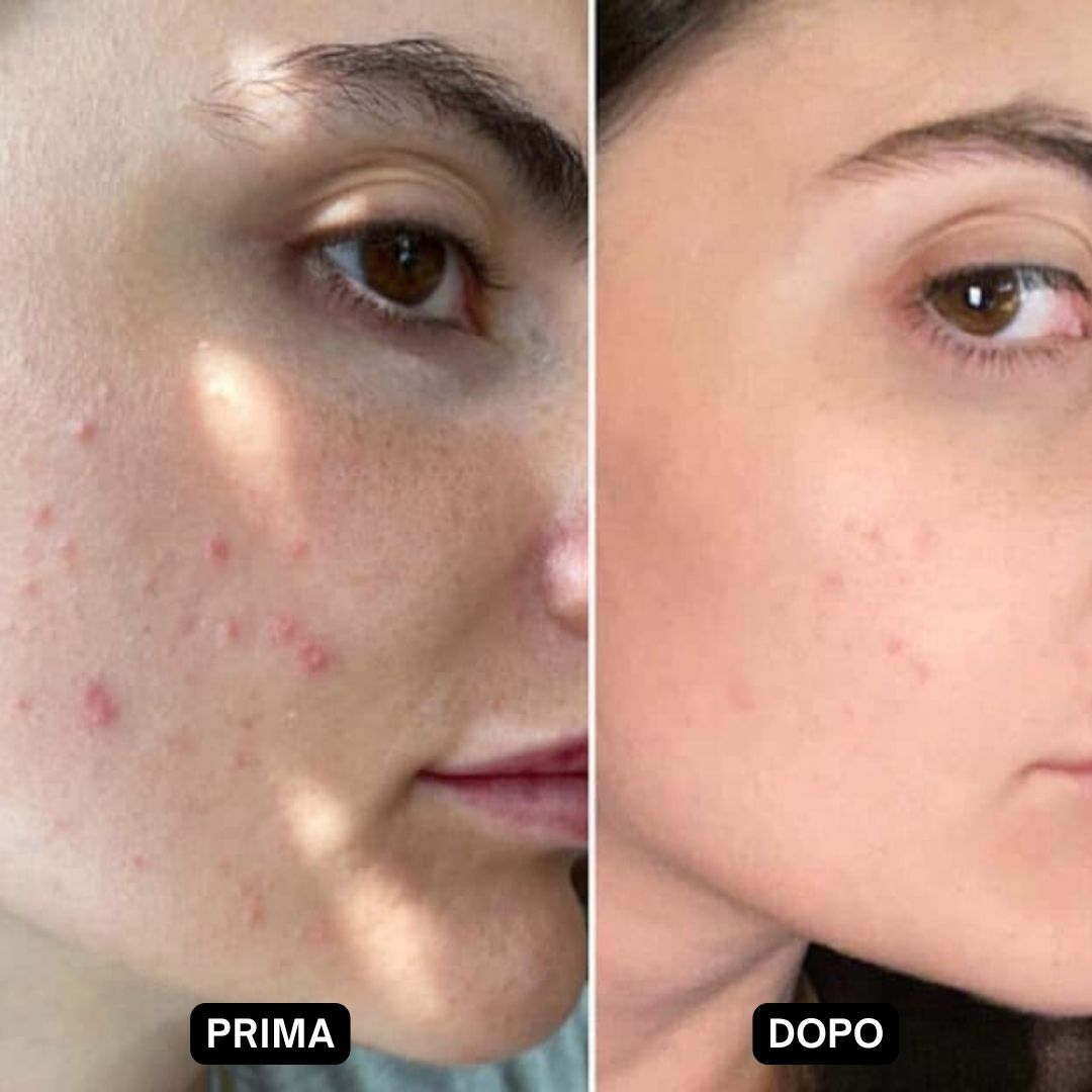 Confronto prima-dopo. Viso con acne prima e dopo il trattamento.
