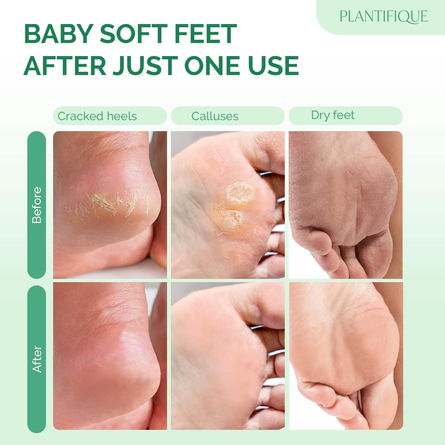 Confronto prima-dopo: talloni screpolati, calli, piedi secchi. Dopo il trattamento: pelle liscia. Testo: Baby Soft Feet. Plantifique.