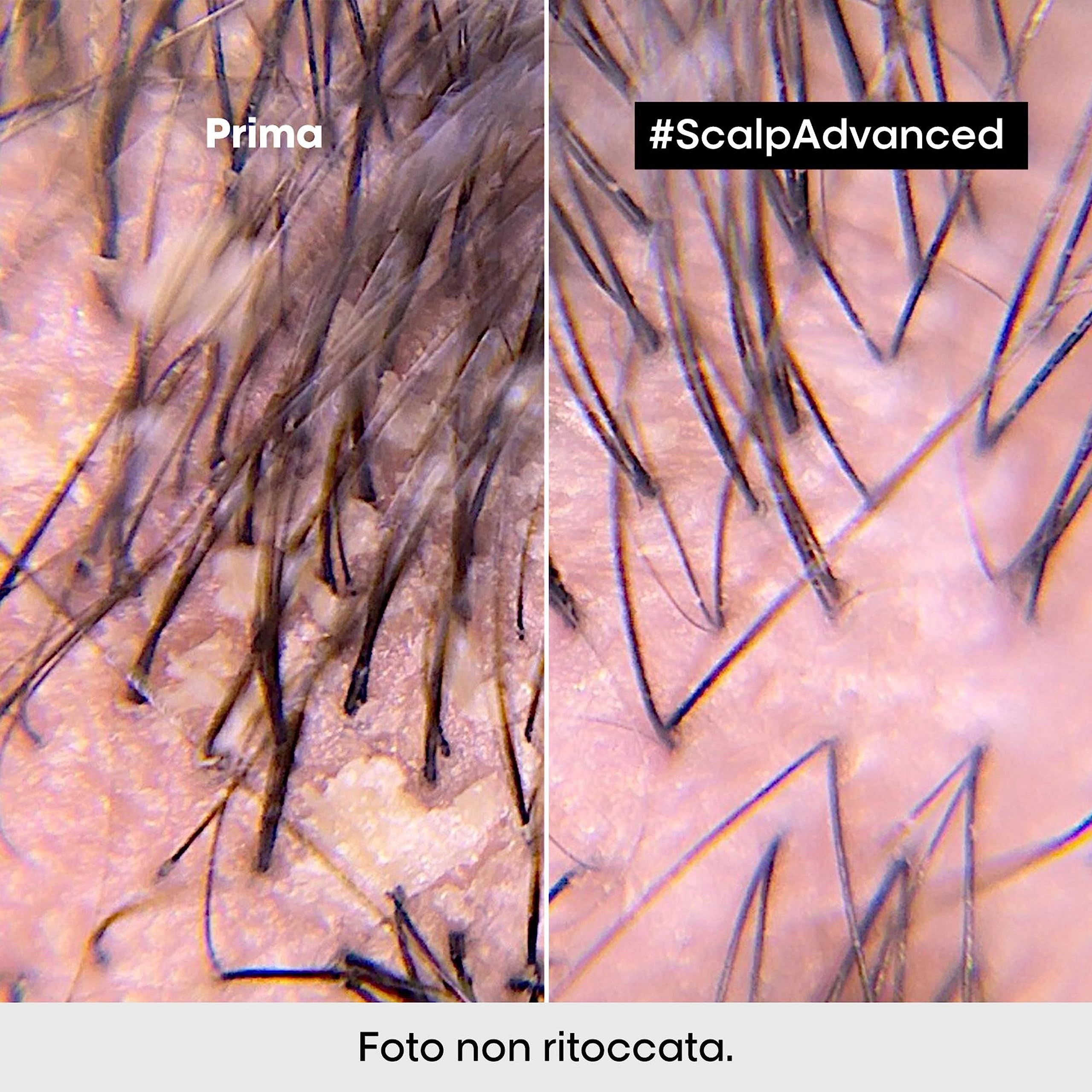 Primo piano microscopico del cuoio capelluto. A sinistra: cuoio capelluto con forfora. A destra: cuoio capelluto pulito. Testo: Foto non ritoccata.