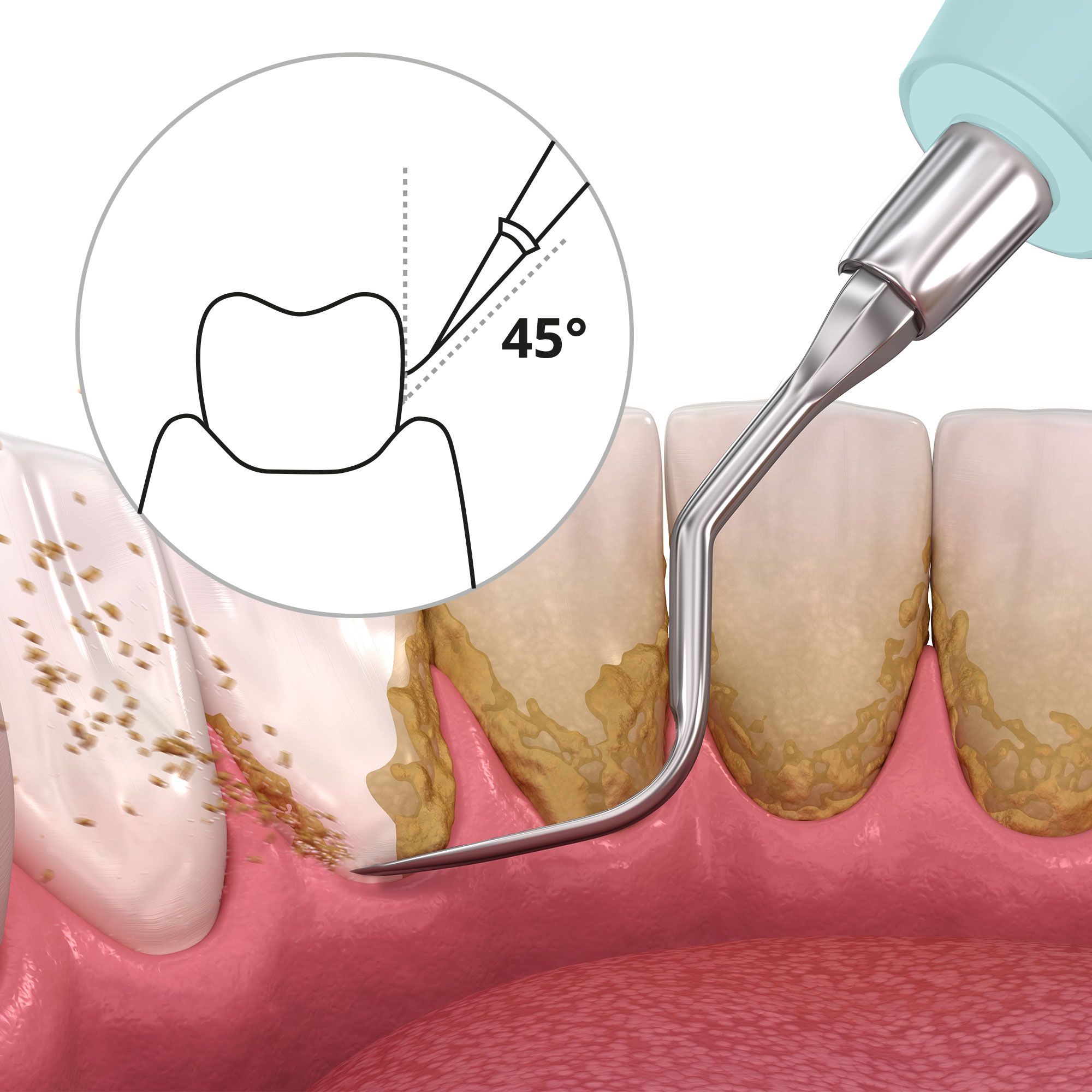 Applicazione del pulitore dentale. Illustrazione della punta su un dente. Angolo di 45 gradi. Dente con depositi.