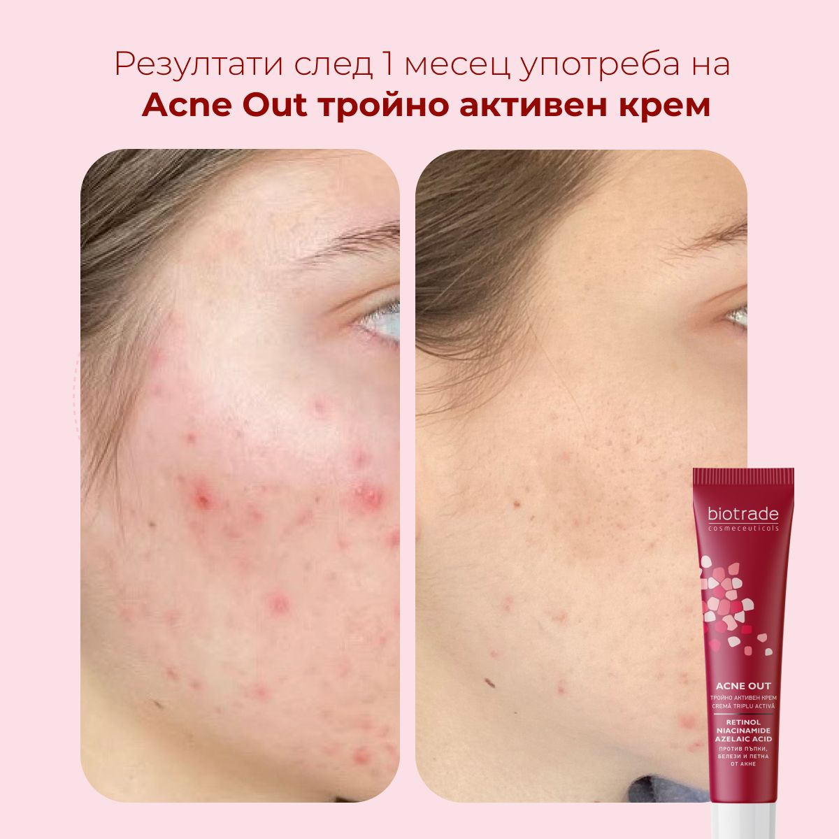 Confronto prima-dopo di pelle con acne. Accanto, tubo con scritta: ACNE OUT, Retinolo, Niacinamide, Acido Azelaico. Marchio: Biotrade.