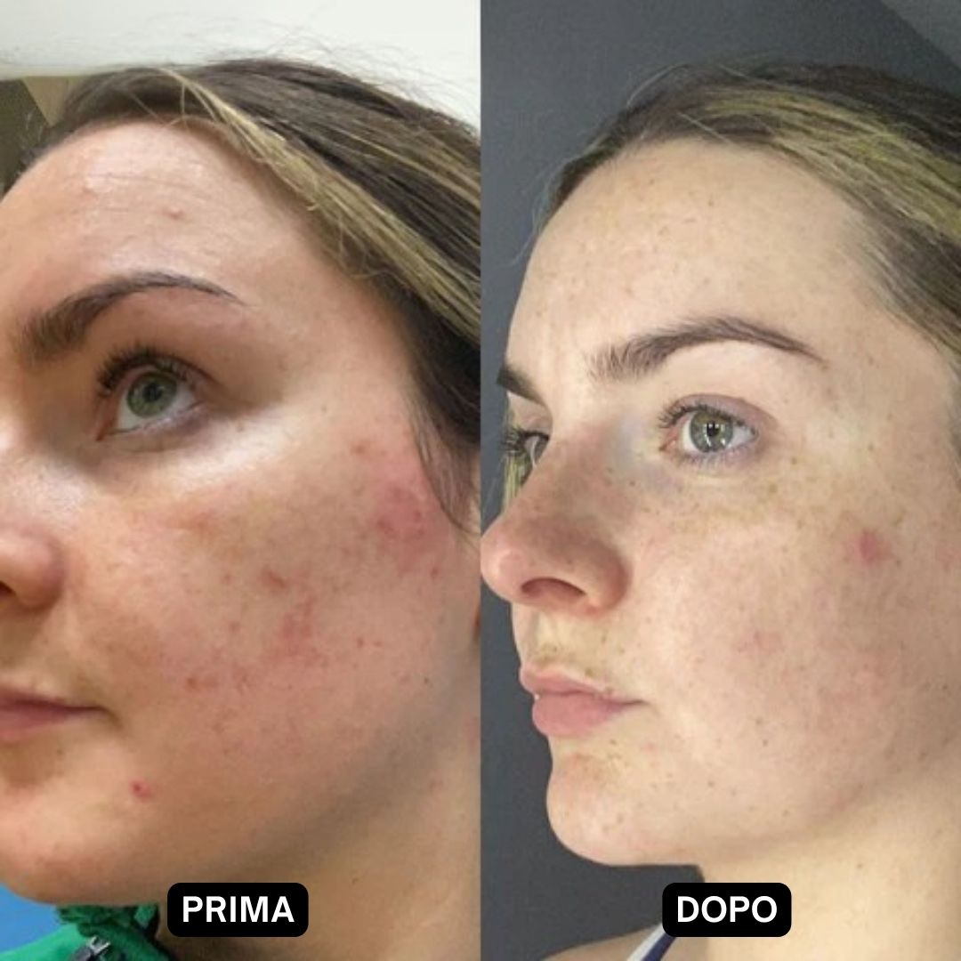 Confronto prima-dopo. Viso con imperfezioni. Dopo: pelle notevolmente migliorata.