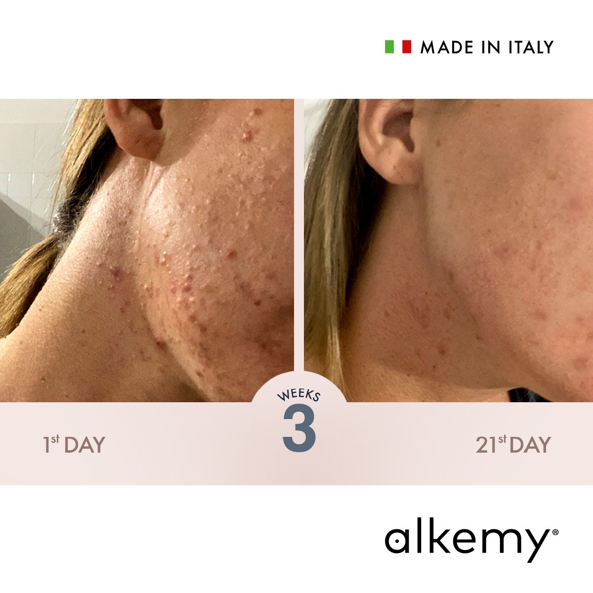 Alkemy Crema Brufoli Viso, Trattamento anti Acne Riduce Brufoli, Imperfezioni, Rossori