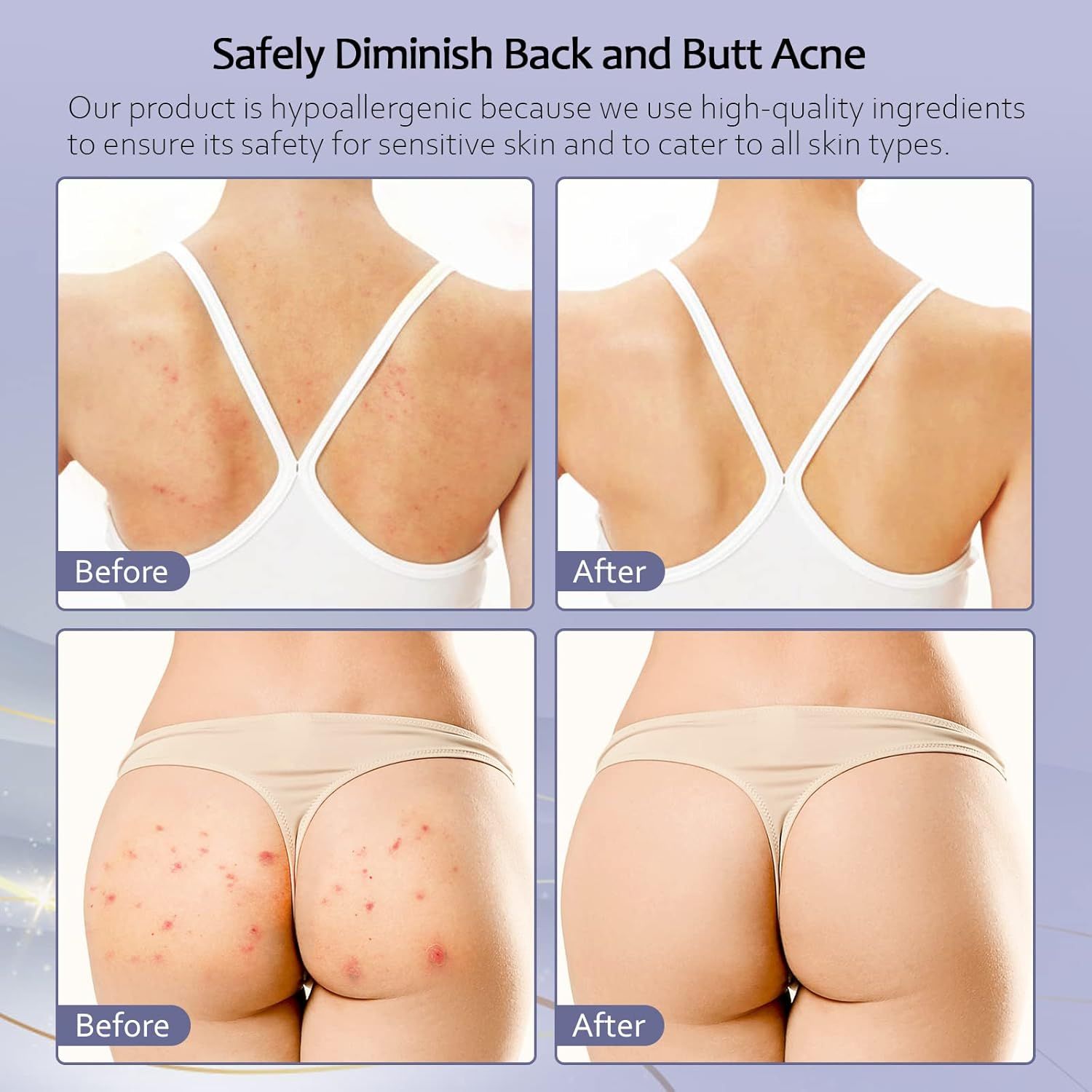 Immagini prima-dopo di schiena e glutei. Testo: Safely Diminish Back and Butt Acne.