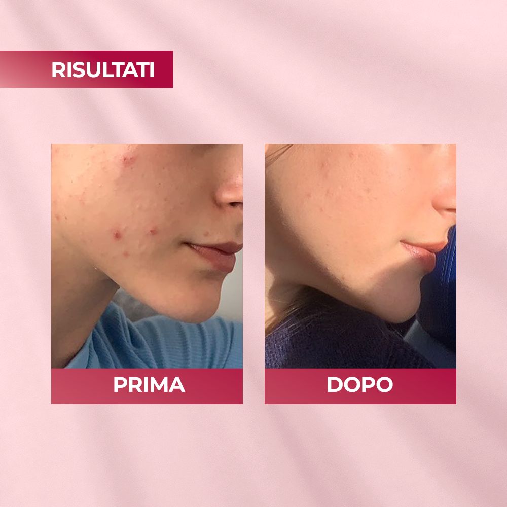 Confronto prima-dopo. Mostra la pelle con imperfezioni prima e dopo l'uso di ACNAUT ACTIVE CREAM.