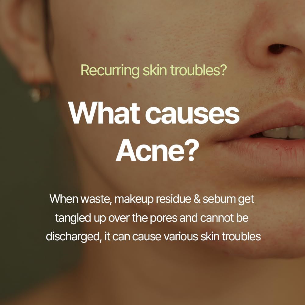 Primo piano di un viso. Testo: What causes Acne? Quando rifiuti, residui di trucco e sebo si aggrovigliano, possono causare problemi alla pelle.