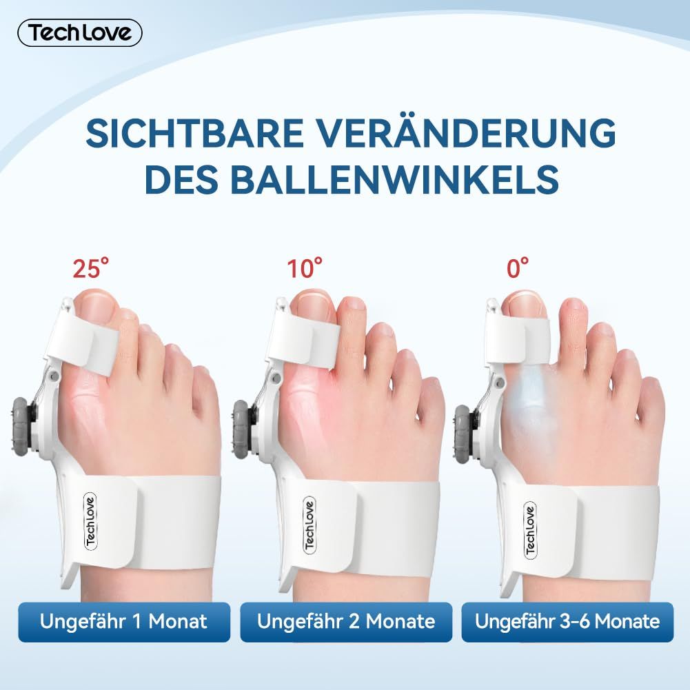Un'infografica che mostra il cambiamento visibile dell'angolo dell'alluce valgo con il correttore Tech Love. Mostra tre fasi di correzione in un periodo da 1 a 6 mesi. Il correttore viene indossato sul piede e ha una manopola rotante.