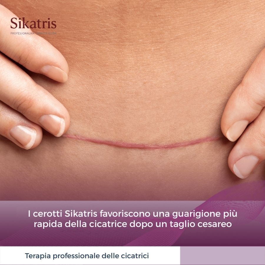 Primo piano di un ventre con una cicatrice. Testo: 'I cerotti Sikatris favoriscono una guarigione più rapida della cicatrice dopo un taglio cesareo'.