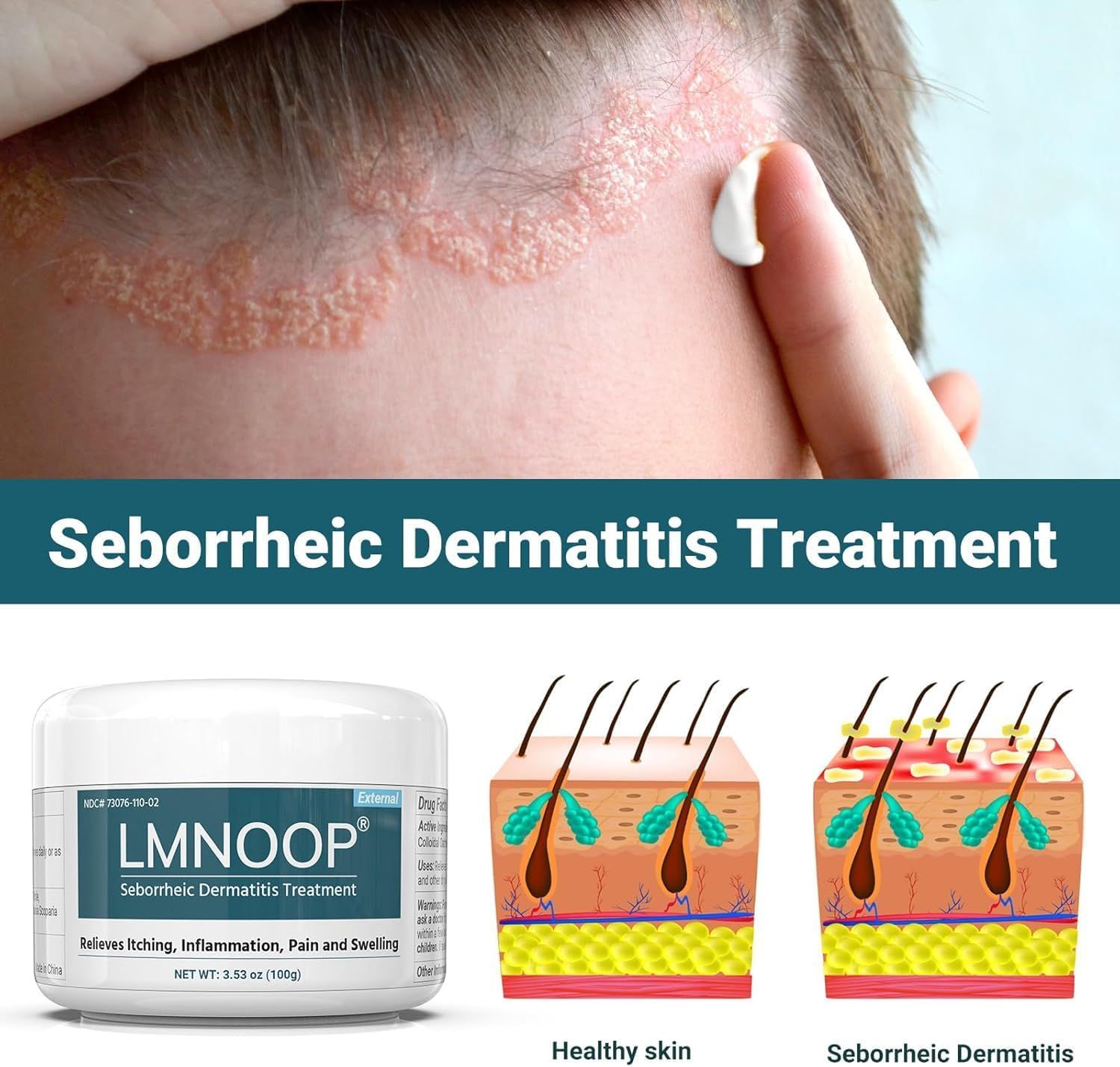 LMNOOP crema per dermatite seborroica trattamento intensivo per il cuoio capelluto