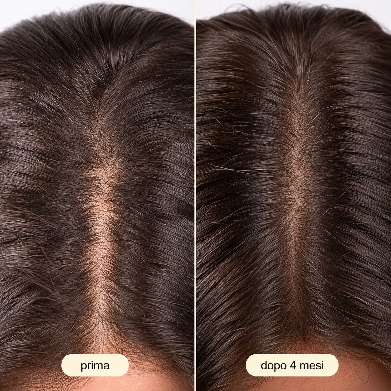 Confronto cuoio capelluto prima e dopo 4 mesi. Migliorata densità e volume dei capelli.