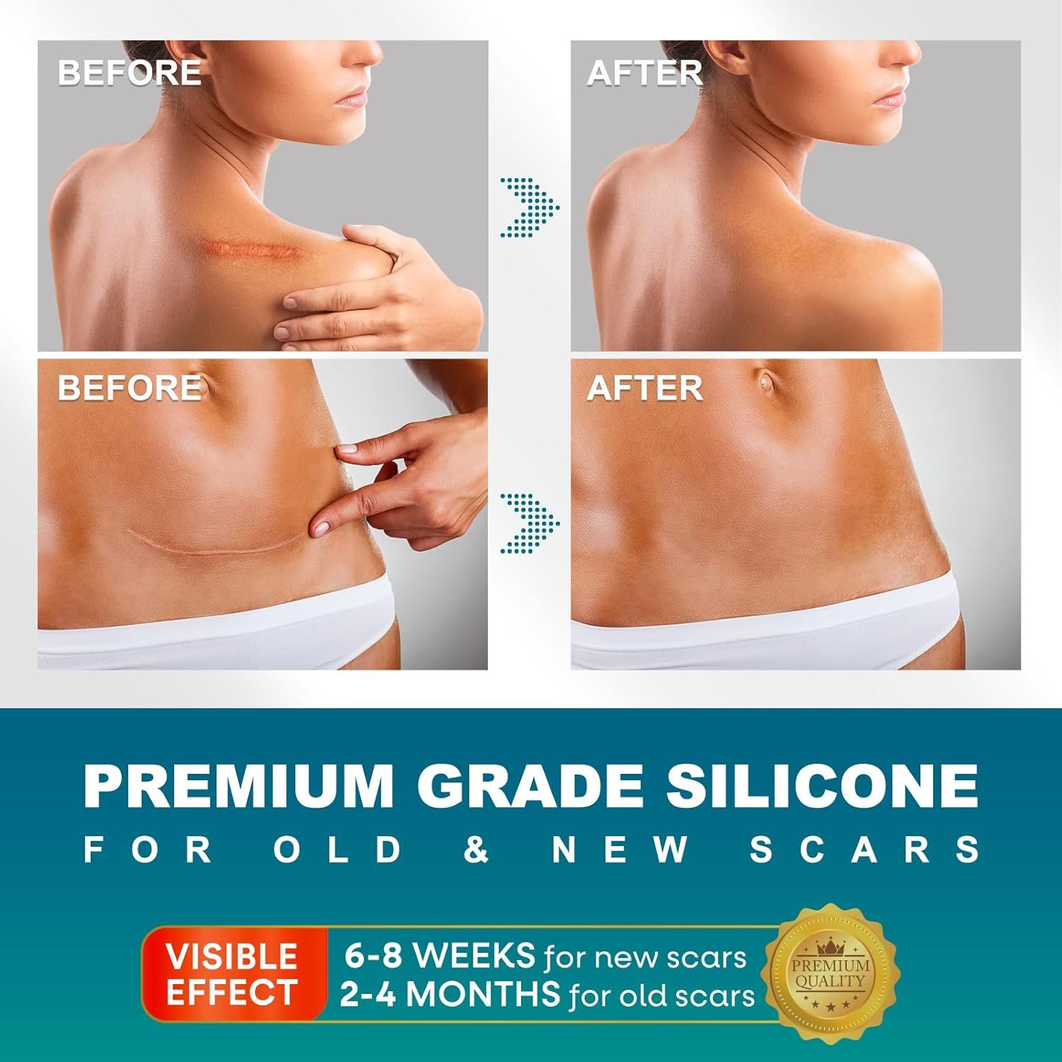 Cerotti in silicone per cicatrici. Confronto prima/dopo. Qualità premium. Effetto visibile in 6-8 settimane per cicatrici recenti, 2-4 mesi per vecchie.