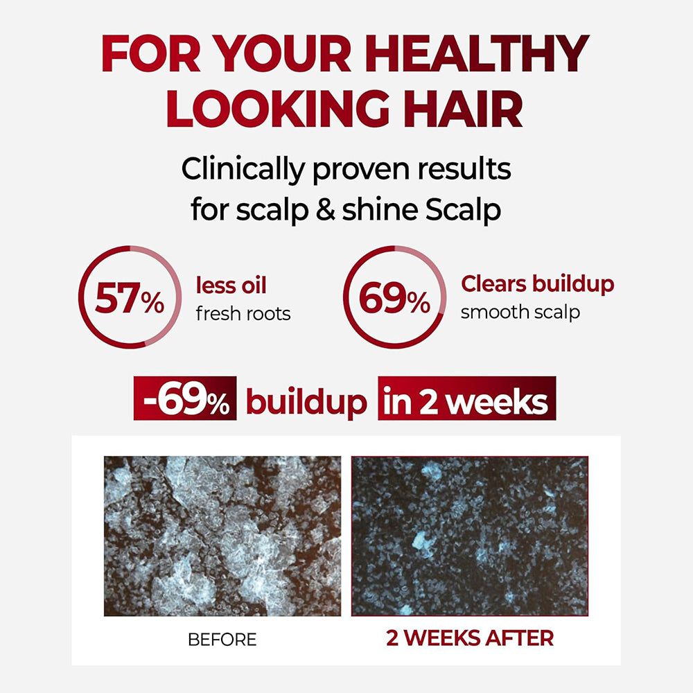 Confronto prima/dopo del cuoio capelluto con accumulo ridotto dopo 2 settimane di shampoo KUNDAL.