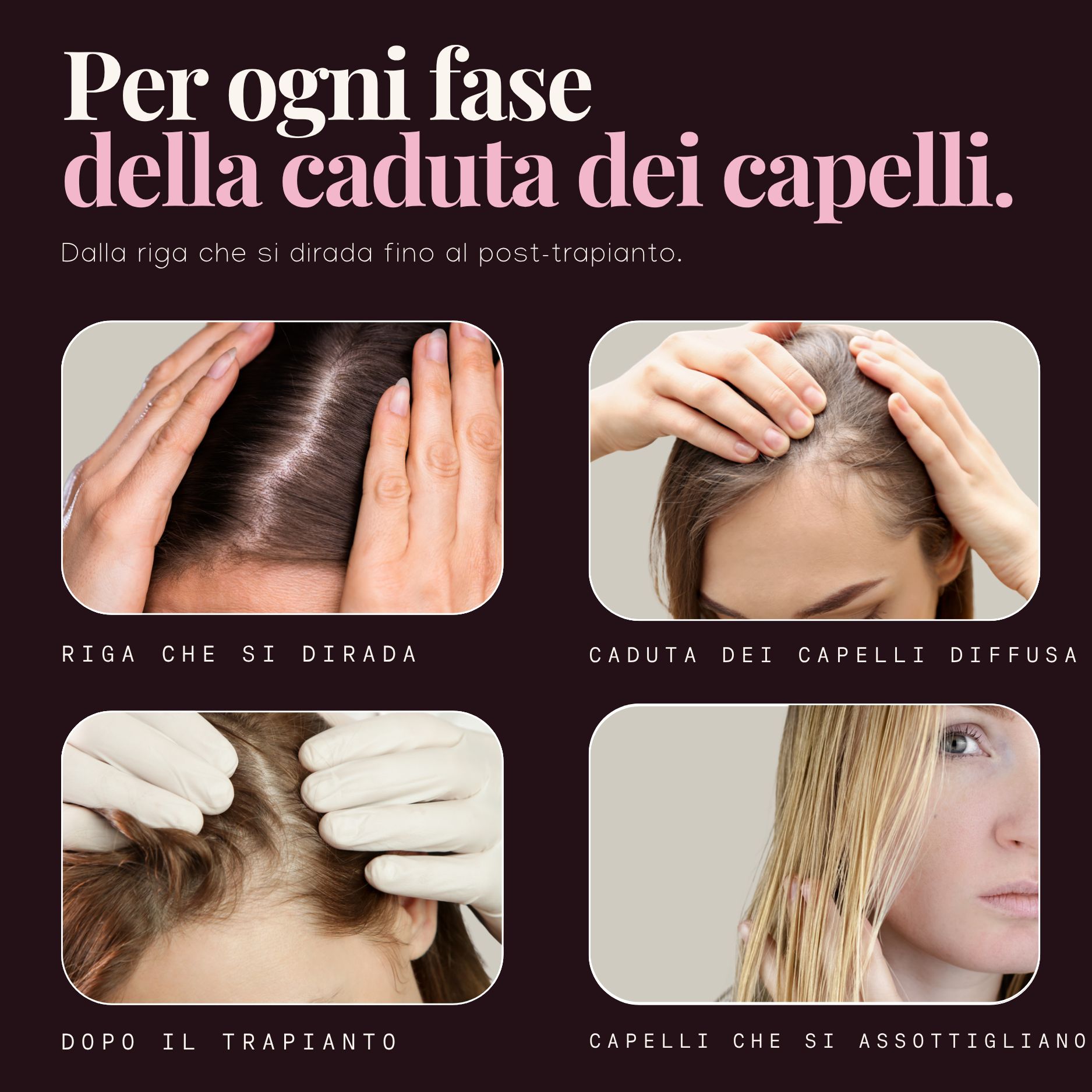 Quattro fasi della caduta dei capelli: riga che si dirada, caduta diffusa, dopo trapianto, capelli che si assottigliano.