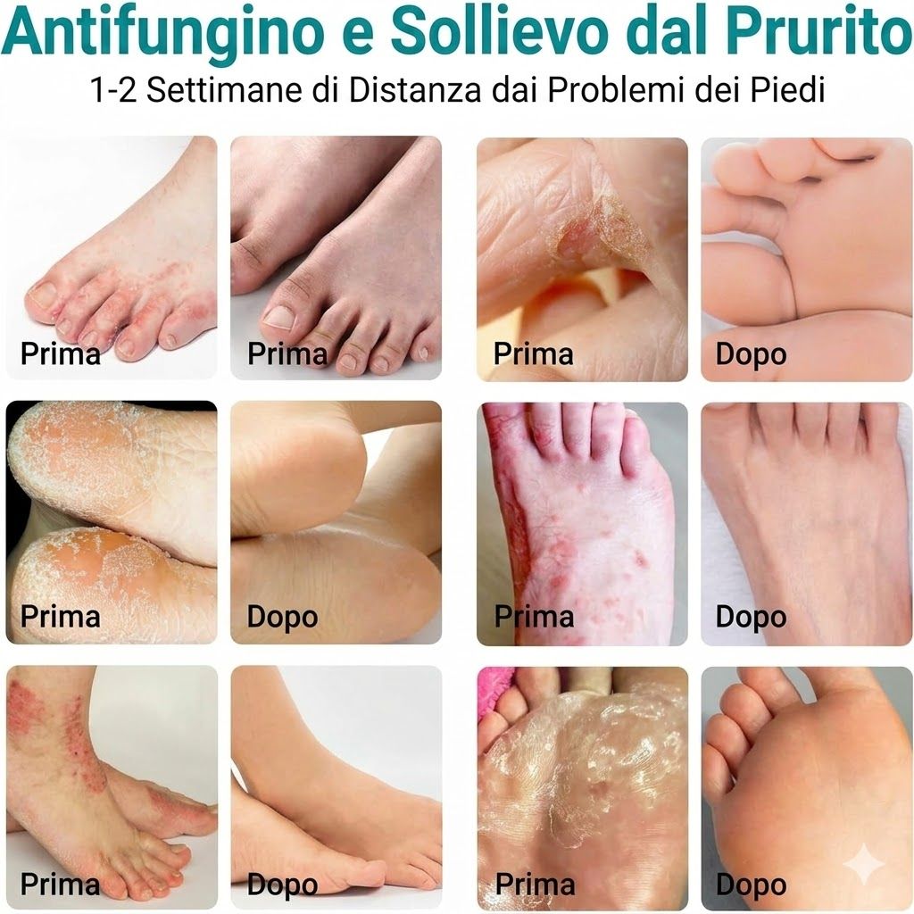 LMNOOP crema trattamento per piede d’atleta