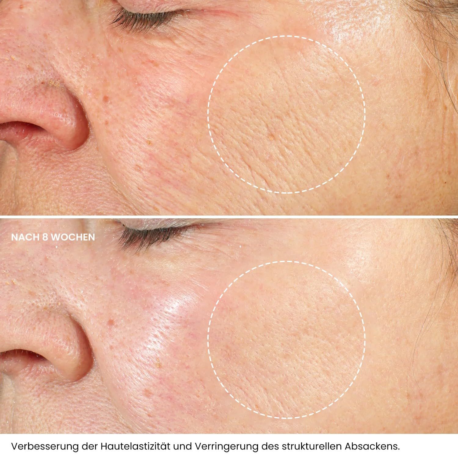 Confronto pelle prima e dopo 8 settimane. Miglioramento visibile. Testo: Migliore elasticità cutanea e riduzione cedimenti strutturali.