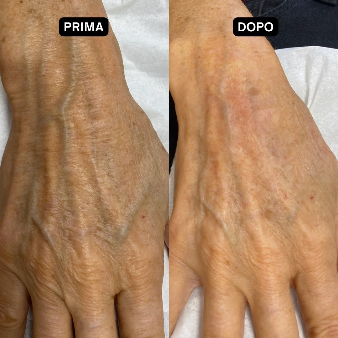 Due mani, una prima e una dopo l'uso. La pelle appare più liscia e meno arrossata dopo l'uso.