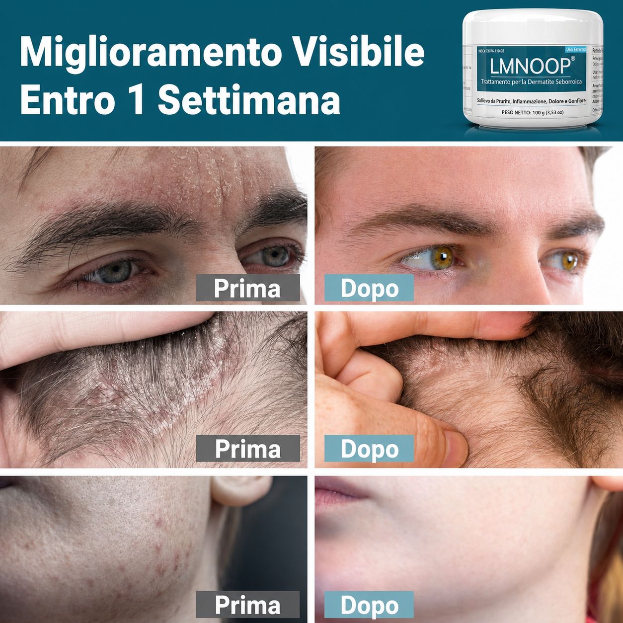 LMNOOP crema per dermatite seborroica trattamento intensivo per il cuoio capelluto
