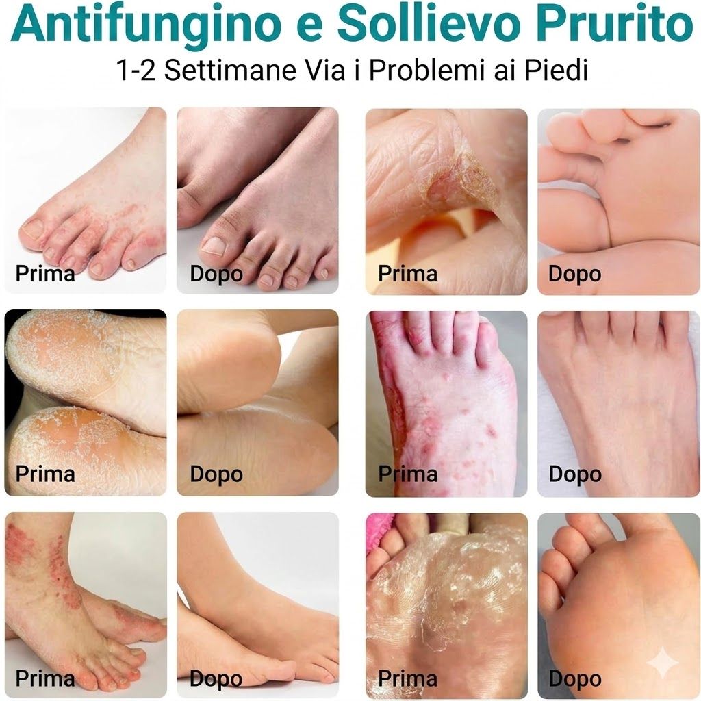 Immagini prima-dopo dei piedi. Testo: Antifungino e Sollievo Prurito. 1-2 Settimane Via i Problemi ai Piedi.