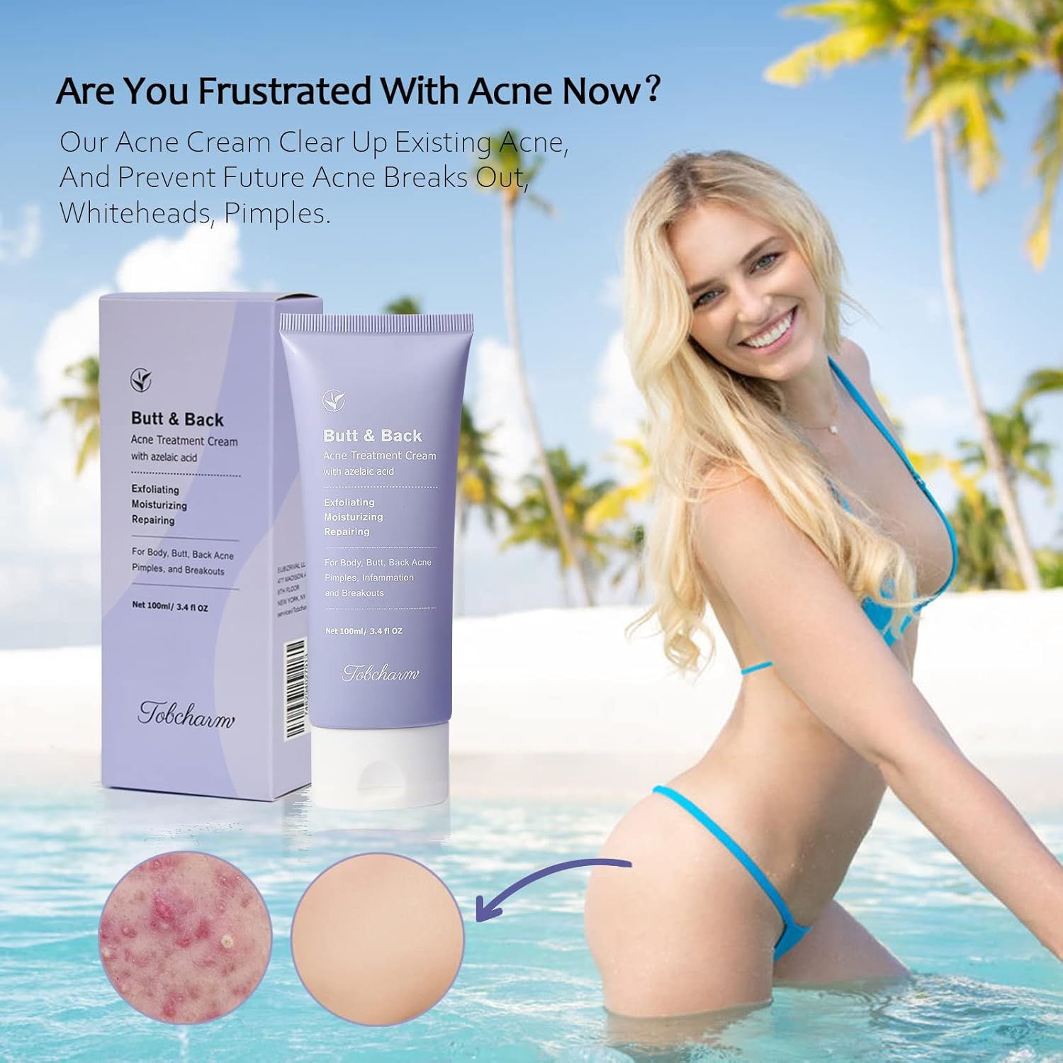 Donna sulla spiaggia con "Back & Butt Akne Creme" e immagine del prodotto. Testo sull'acne.