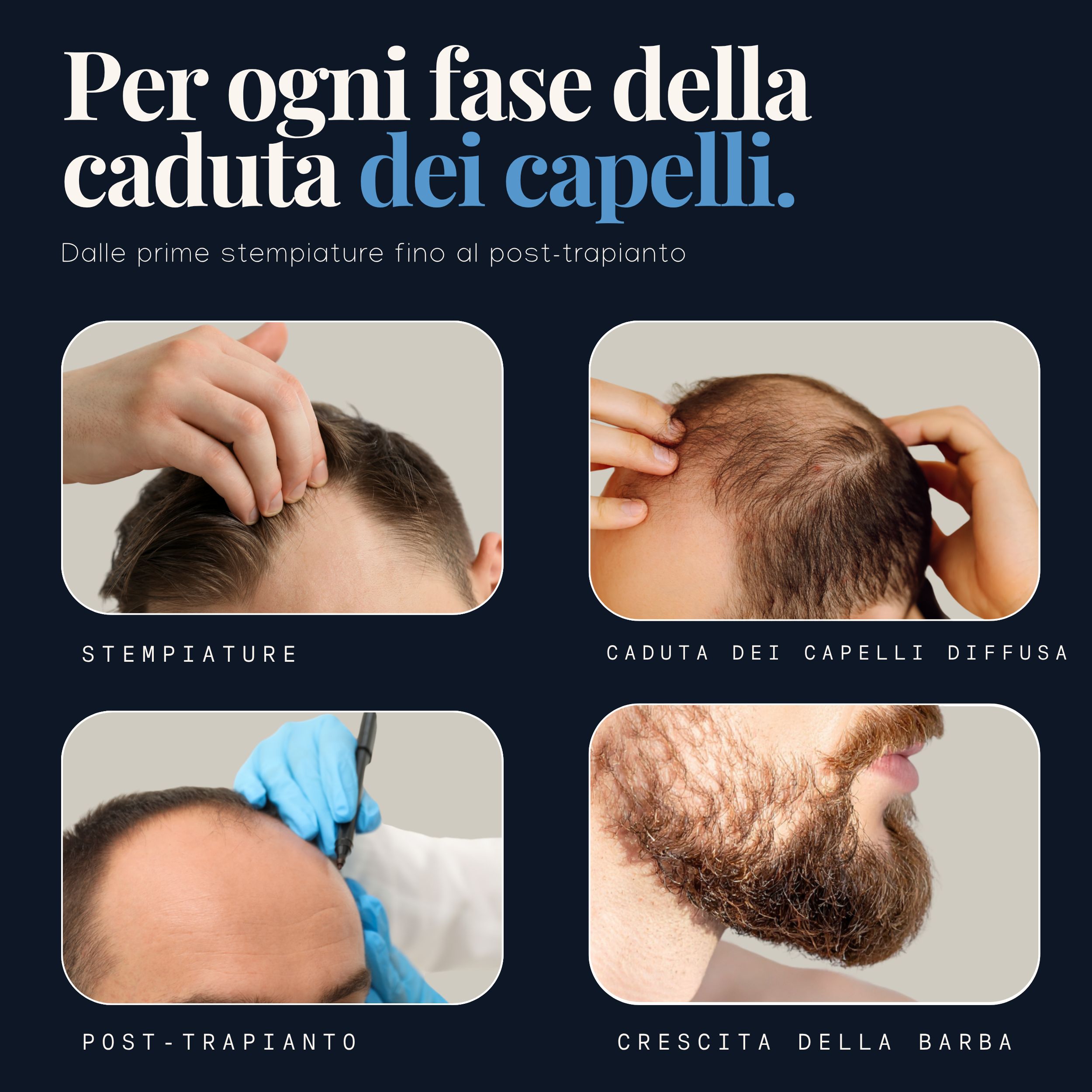 Hairforte Spray 3% Procapil contro la perdita dei capelli, bloccante DHT