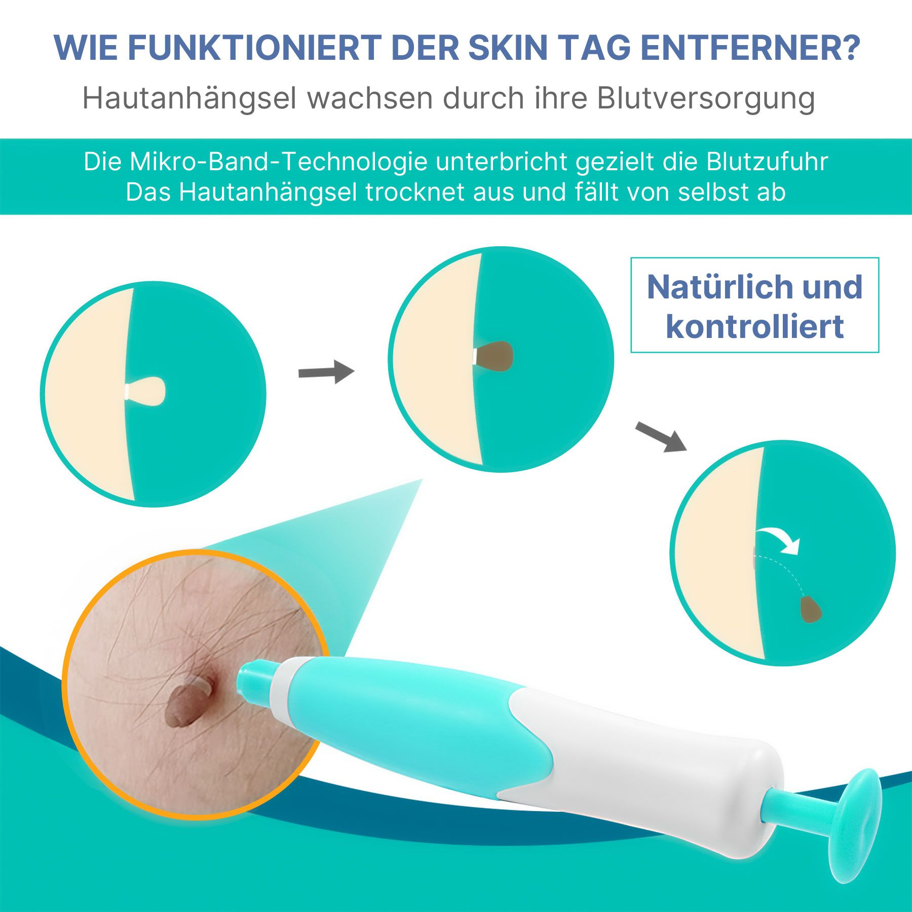 ALIVER Set Penna per il Trattamento delle Verruche e Rimozione di Fibromi Penduli