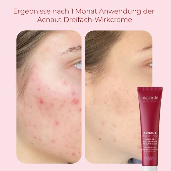 Confronto prima-dopo di pelle con acne. Accanto, tubo con scritta: ACNAUT Triple Active Cream, Retinolo, Niacinamide, Acido Azelaico. Marchio: Biotrade.