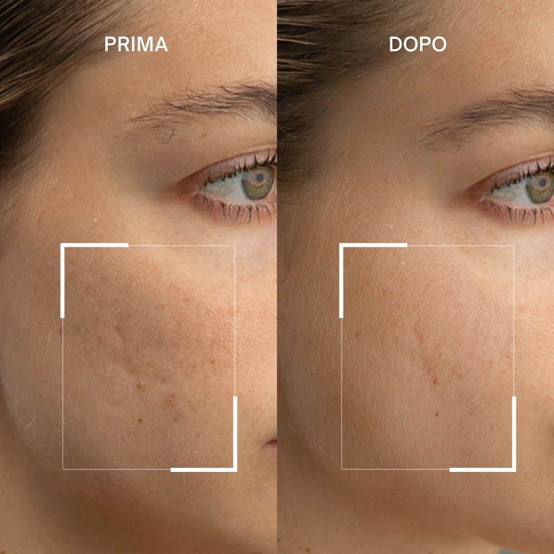 Confronto prima-dopo. Viso con imperfezioni, poi pelle più liscia.